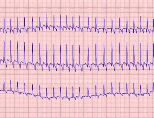 Electrocardiogramme Conventionnel